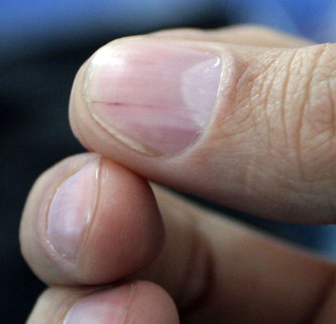 (图)有个问题,我的指甲里有血丝代表什么?谁知道?先谢谢了!